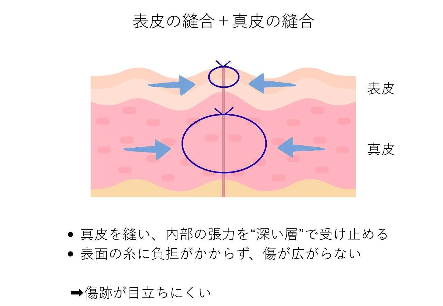 小陰唇縮小術 真皮縫合 図解説明