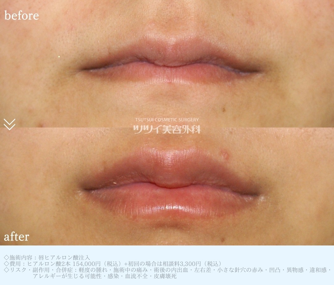 ヒアルロン酸_唇症例