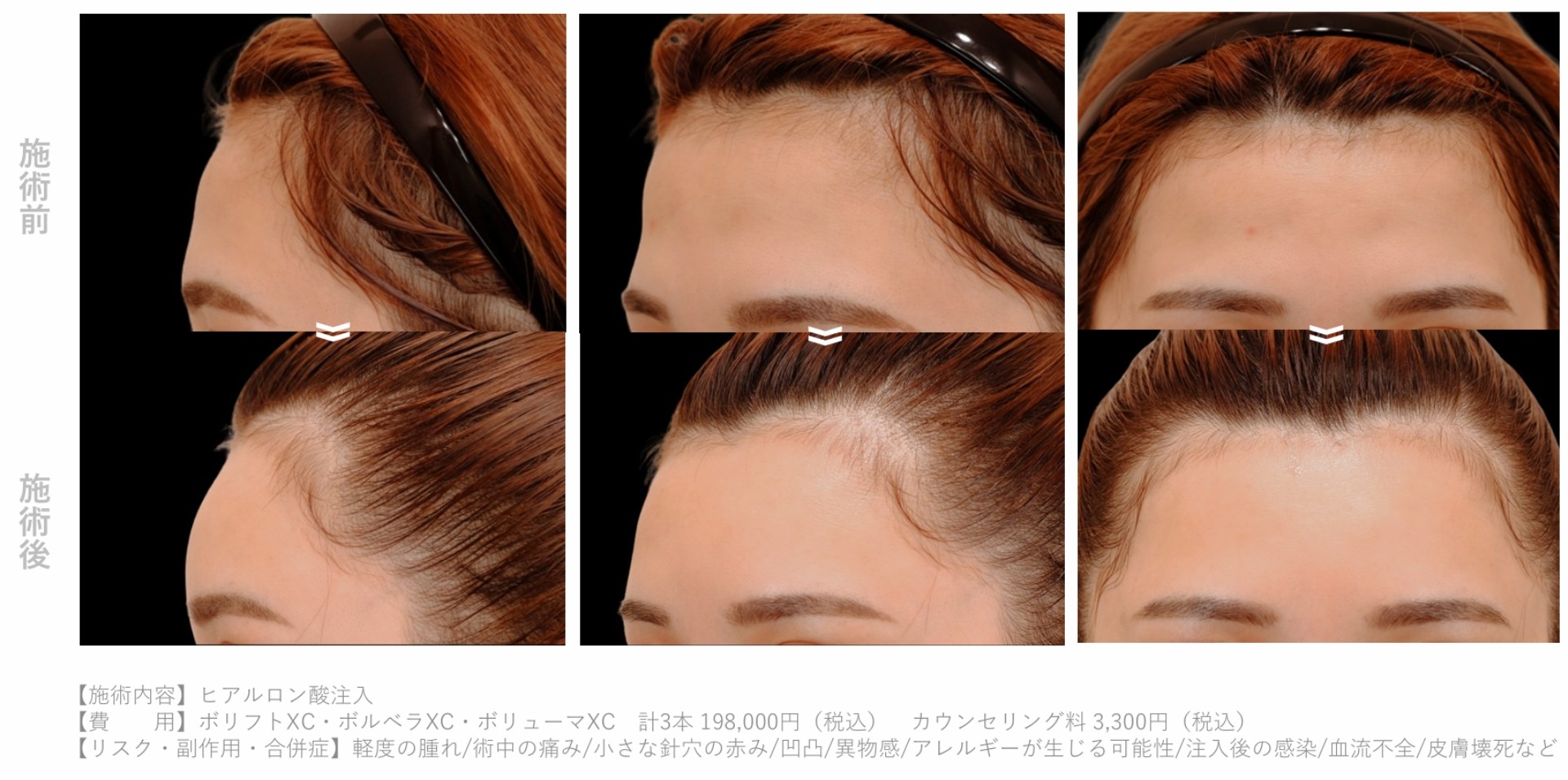 ヒアルロン酸_本数別_額症例3cc