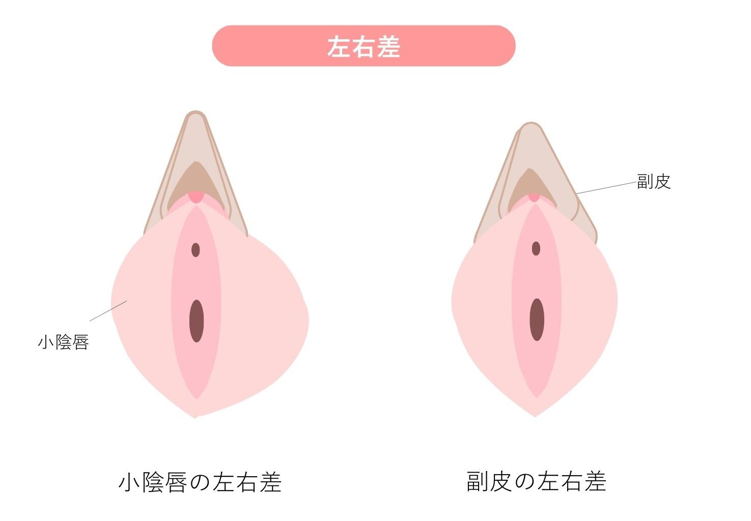 小陰唇 左右差 イラスト説明
