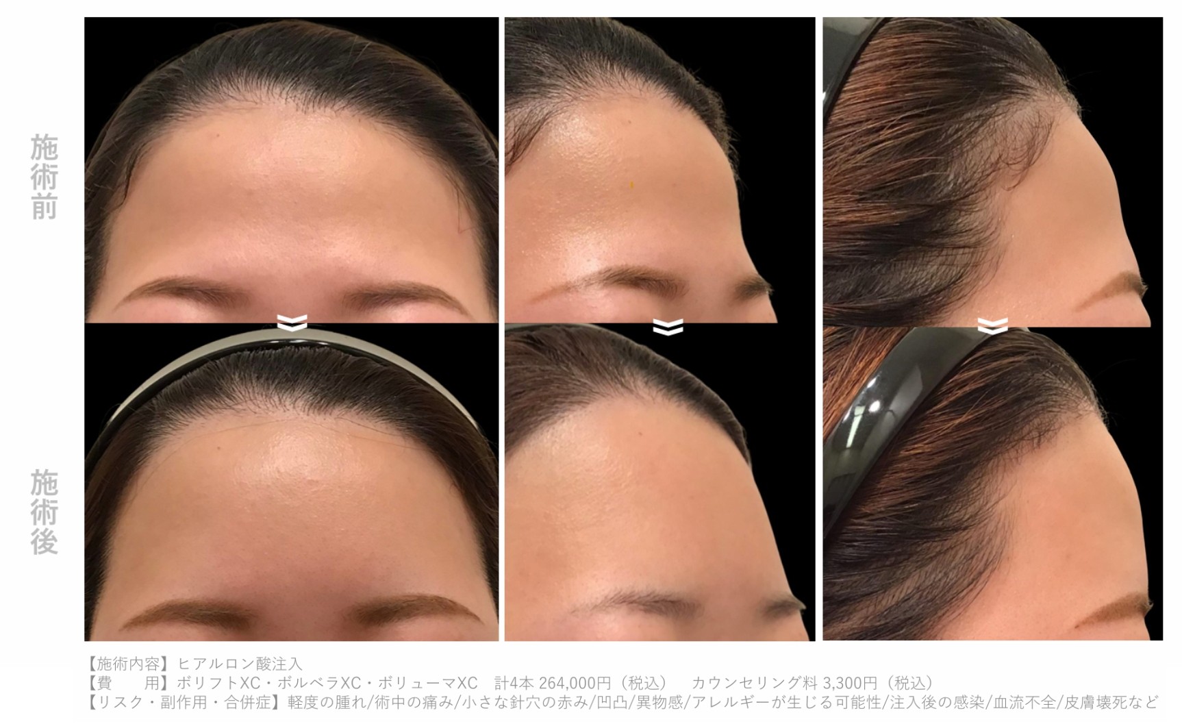 ヒアルロン酸_本数別_額症例4cc以上