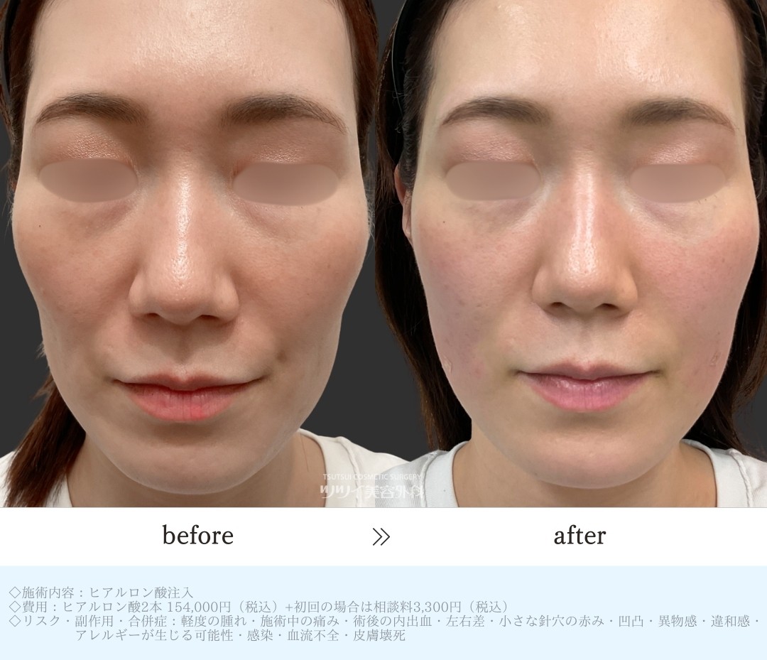 ヒアルロン酸_ほうれい線・頬コケ症例