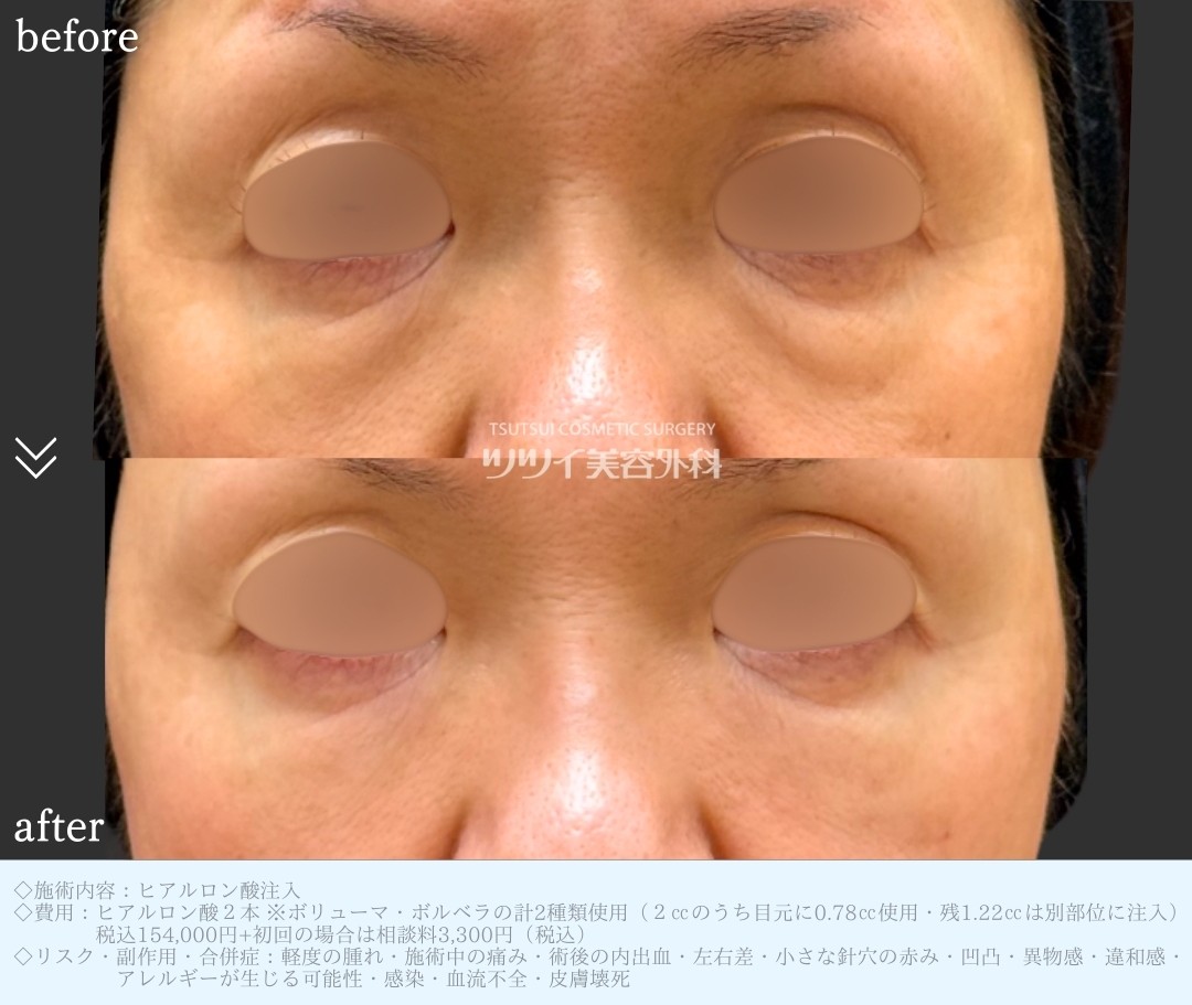 ヒアルロン酸注入_目の下クマ症・たるみ症例