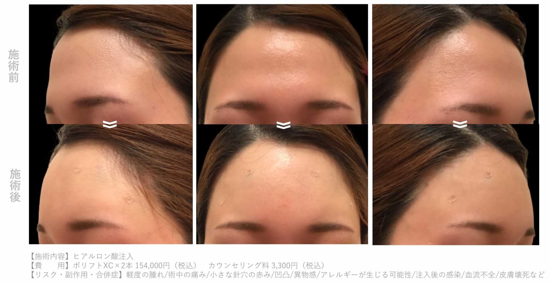 ヒアルロン酸_本数別_額症例2cc